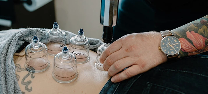 Cupping Therapy In Action